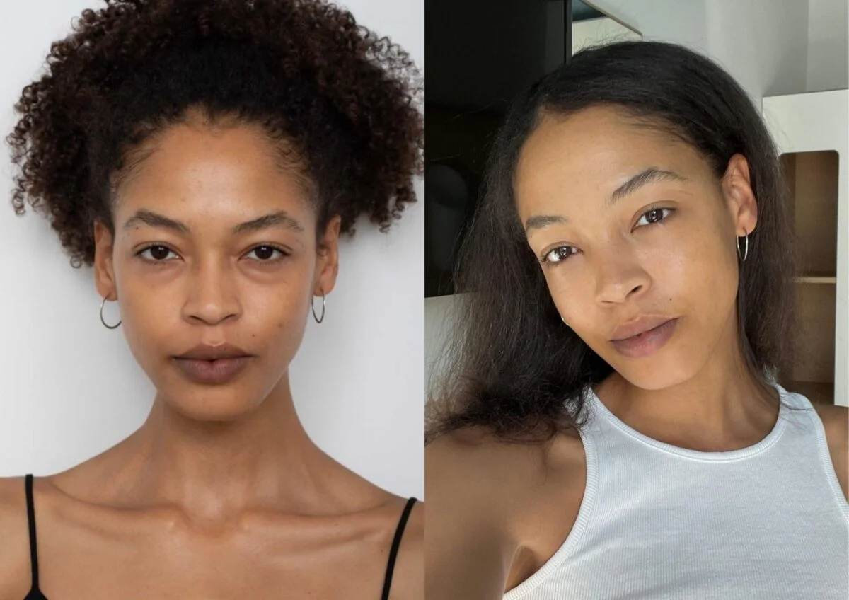 pinch lowered blepharoplasty before/after 10 day