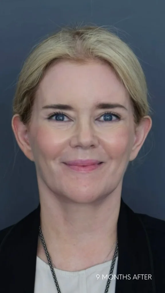 Joyce nine months after her hybrid endoscopic facelift with WaterhouseJanssen, as seen on Channel 4
