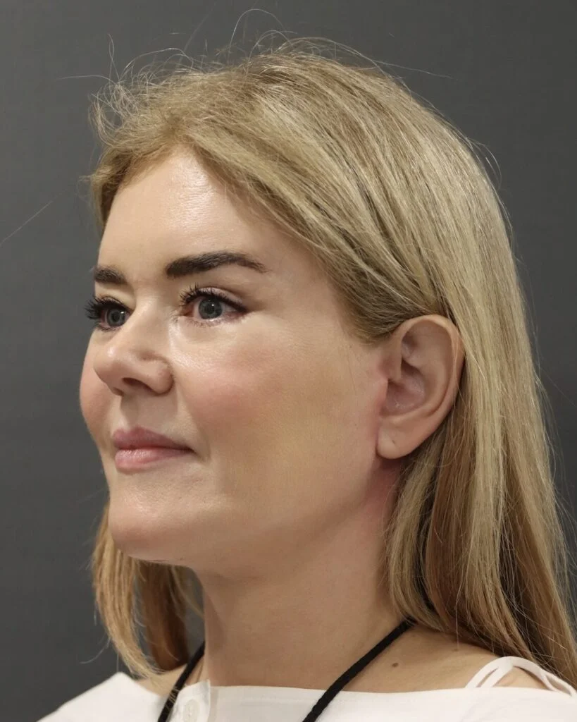 Channel 4 Joyce 6 weeks post endoscopic hybrid facelift