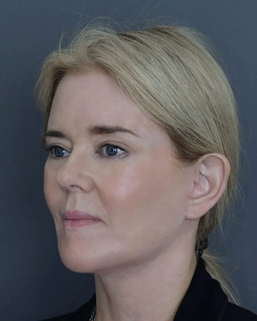 Channel 4 Joyce 9 months post hybrid endoscopic facelift