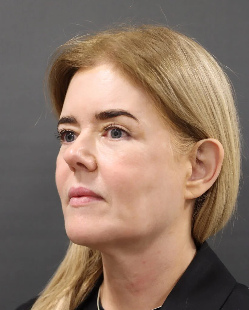 Channel 4 patient Joyce before endoscopic hybrid facelift