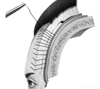 Gliding brow lift diagram