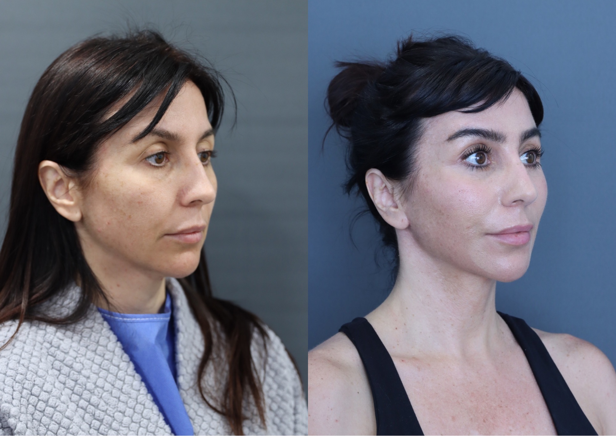 Patient resting during recovery after an endoscopic scarless facelift in London