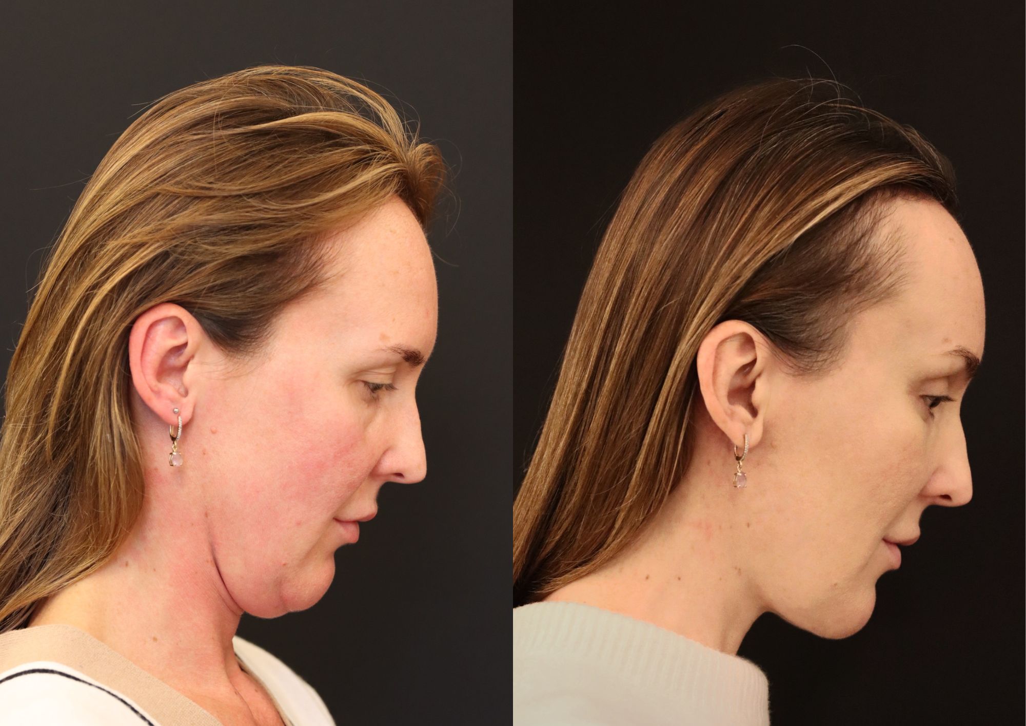 endoscopic face and necklift before after 6 weeks