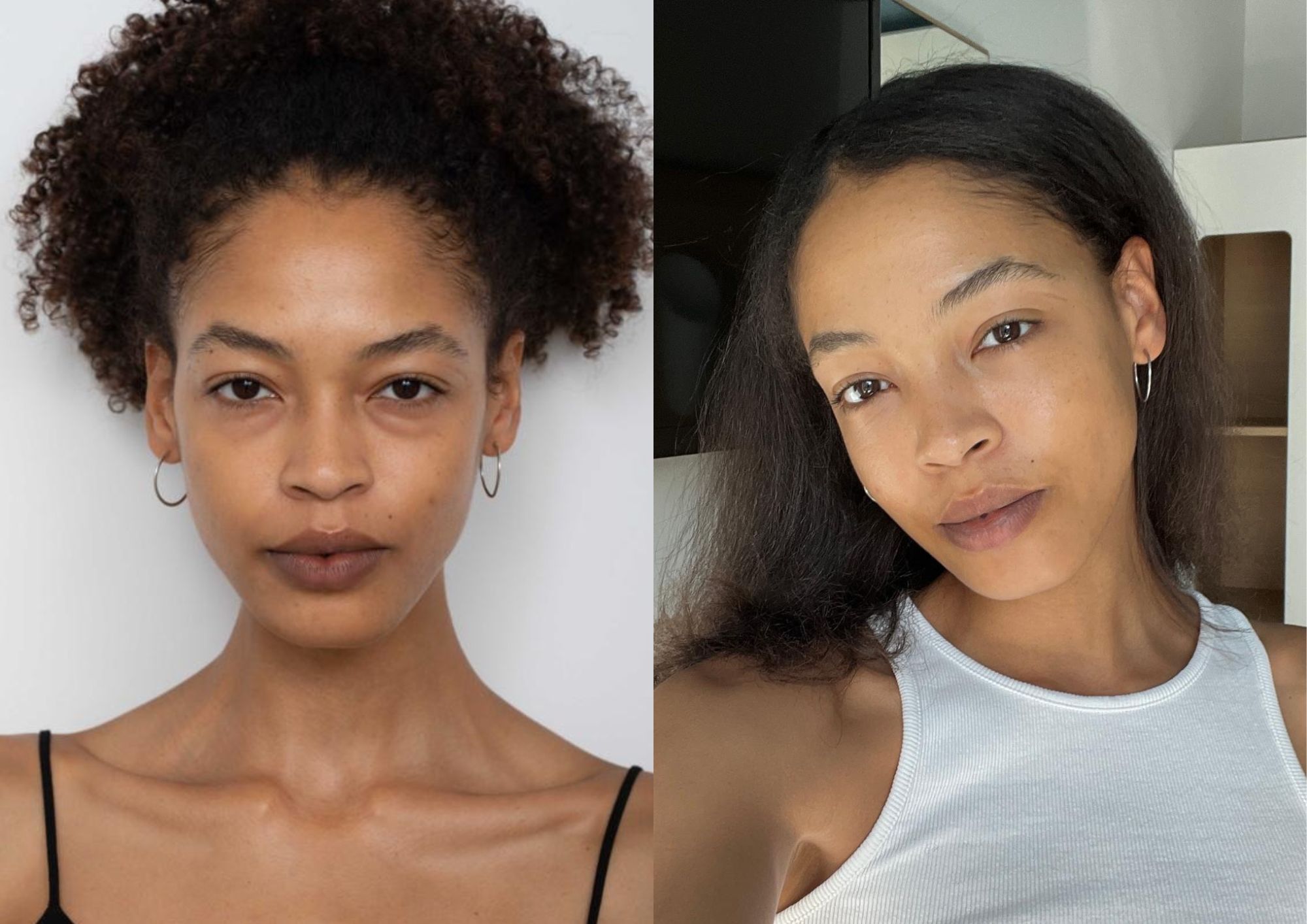 pinch lowered blepharoplasty before/after 10 day