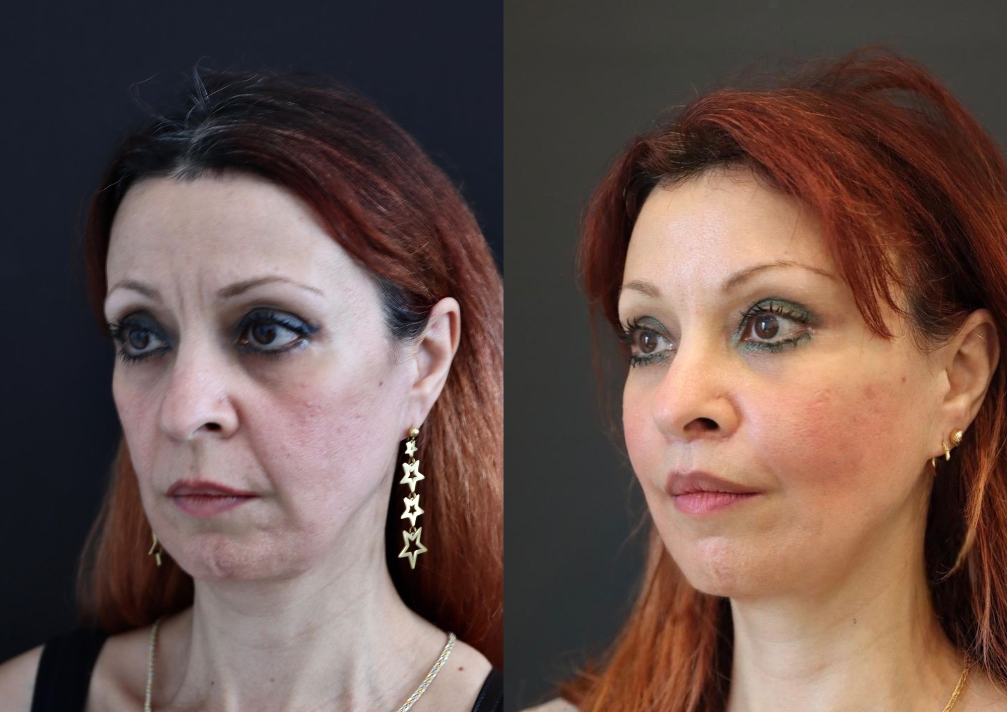 revision endoscopic facelift before after 12 weeks