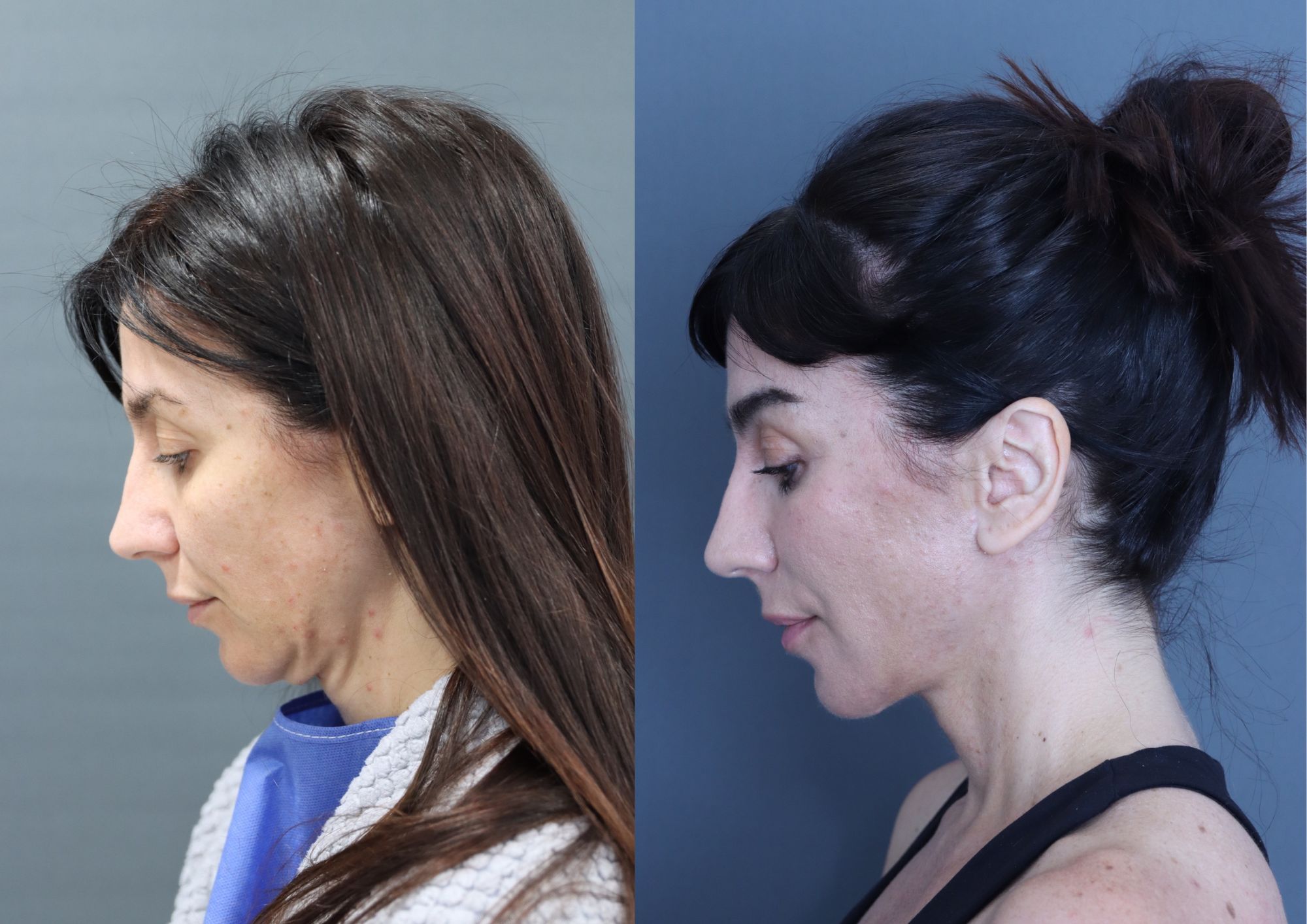 Before and after long-term endoscopic face and necklift result by Dr Tim Janssen