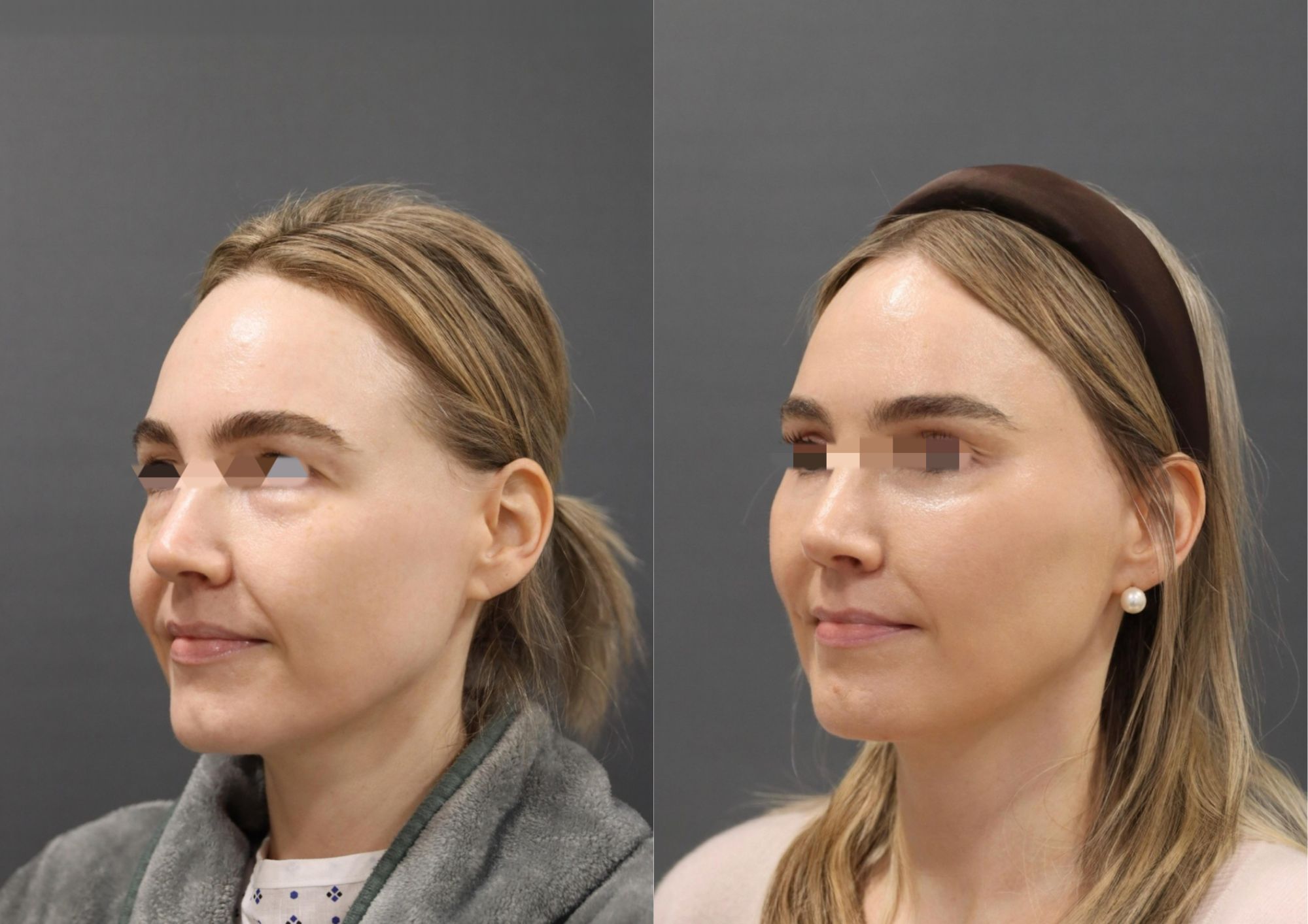Before and after scarless facelift, three-quarter oblique view, 12 weeks post-op