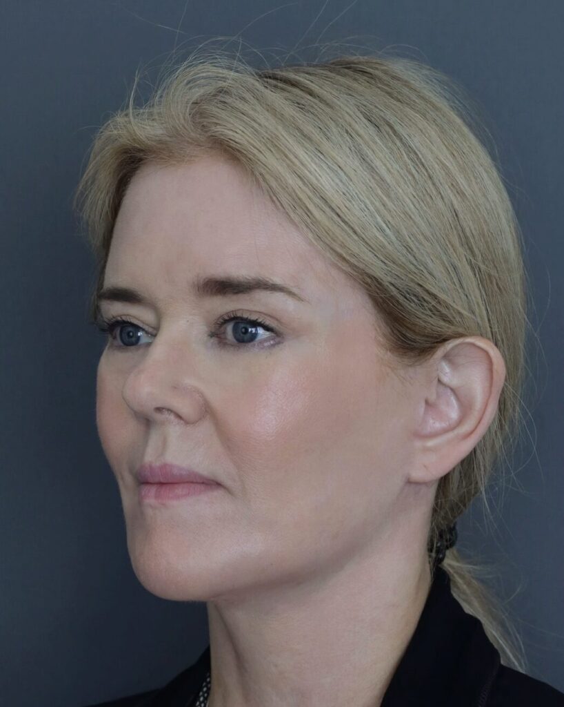 Channel 4 Joyce 9 months post hybrid endoscopic facelift