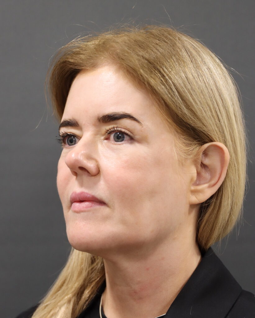 Channel 4 patient Joyce before endoscopic hybrid facelift